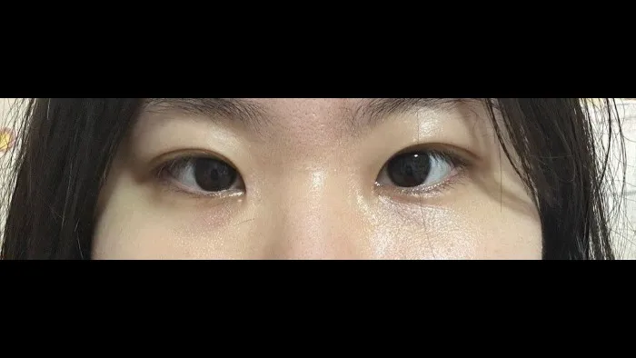 Natural Adhesion Double Eyelid Surgery, Ptosis Correction — RE&RE PLASTIC SURGERY 6