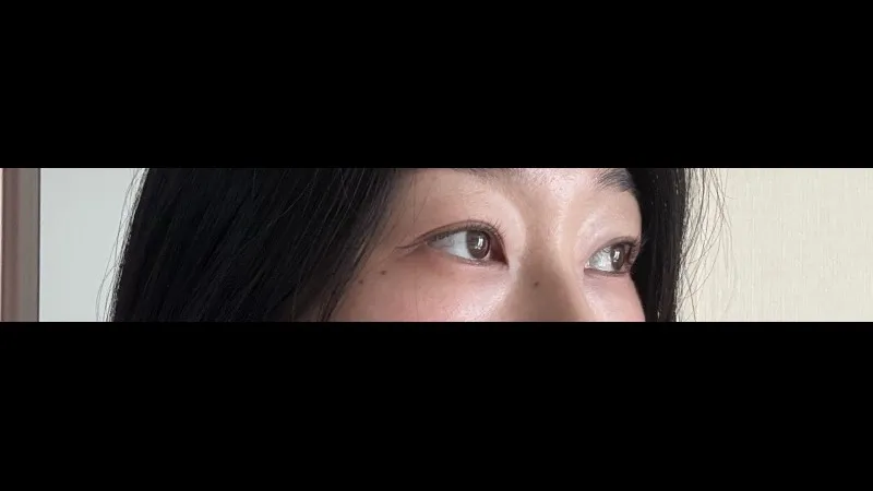 Natural Adhesion Double Eyelid Surgery — RE&RE PLASTIC SURGERY 2