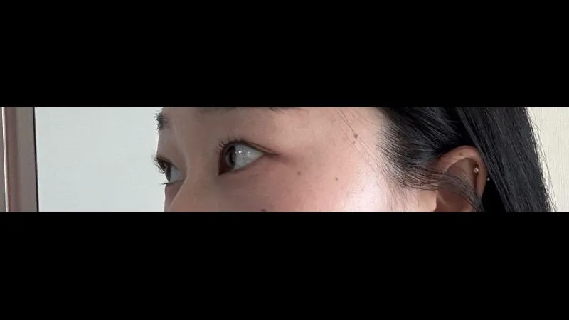 Natural Adhesion Double Eyelid Surgery — RE&RE PLASTIC SURGERY 3