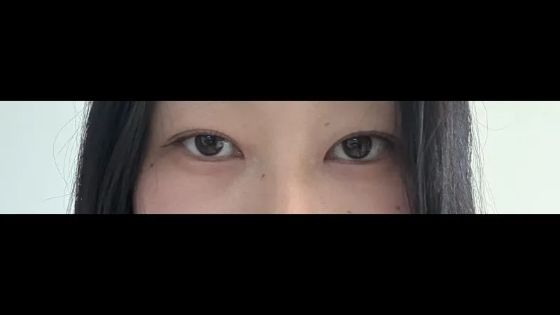 Natural Adhesion Double Eyelid Surgery — RE&RE PLASTIC SURGERY 4