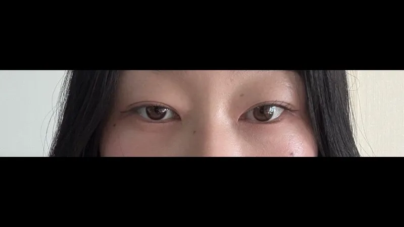 Natural Adhesion Double Eyelid Surgery — RE&RE PLASTIC SURGERY 5