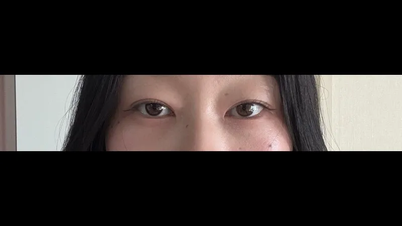 Natural Adhesion Double Eyelid Surgery — RE&RE PLASTIC SURGERY 6