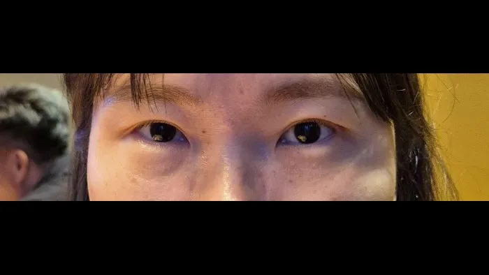 Sub-brow Lift, Ptosis Correction — RE&RE PLASTIC SURGERY 2