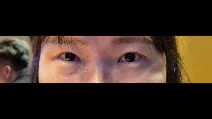 Sub-brow Lift, Ptosis Correction — RE&RE PLASTIC SURGERY 3