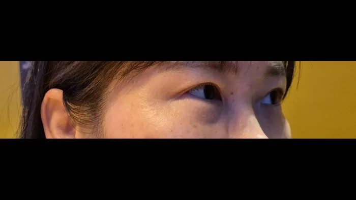 Sub-brow Lift, Ptosis Correction — RE&RE PLASTIC SURGERY 4