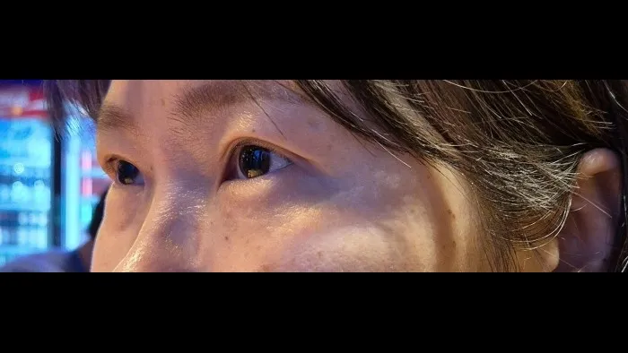 Sub-brow Lift, Ptosis Correction — RE&RE PLASTIC SURGERY 5
