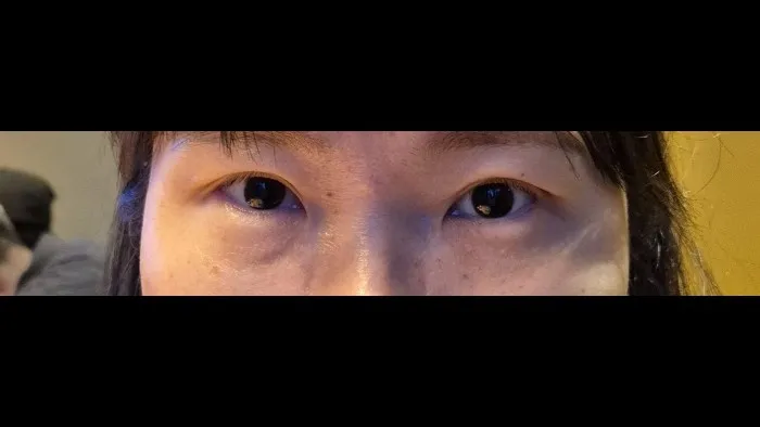Sub-brow Lift, Ptosis Correction — RE&RE PLASTIC SURGERY 6