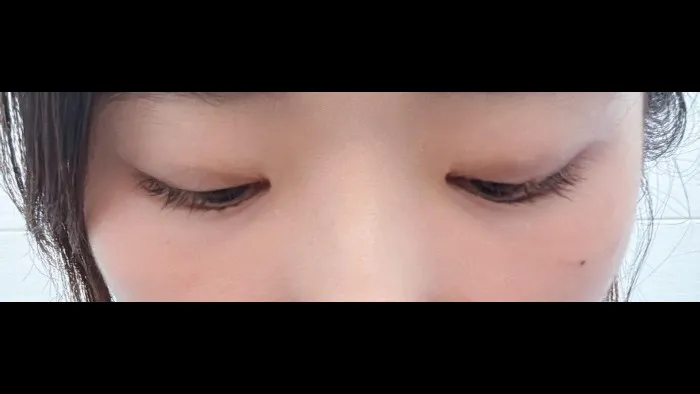 Natural Adhesion Double Eyelid Surgery — RE&RE PLASTIC SURGERY 2
