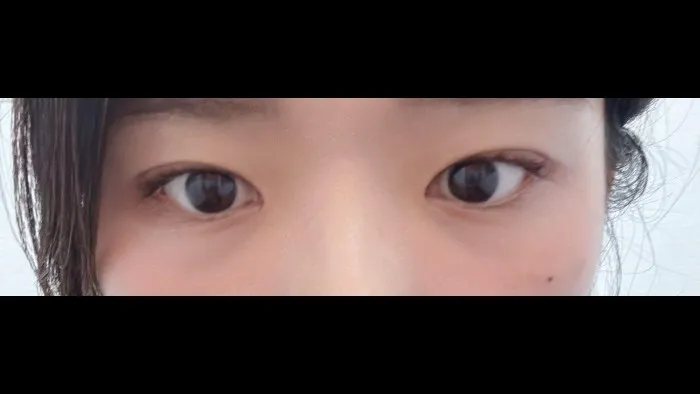 Natural Adhesion Double Eyelid Surgery — RE&RE PLASTIC SURGERY 3