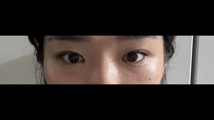 Natural Adhesion Double Eyelid Surgery — RE&RE PLASTIC SURGERY 4