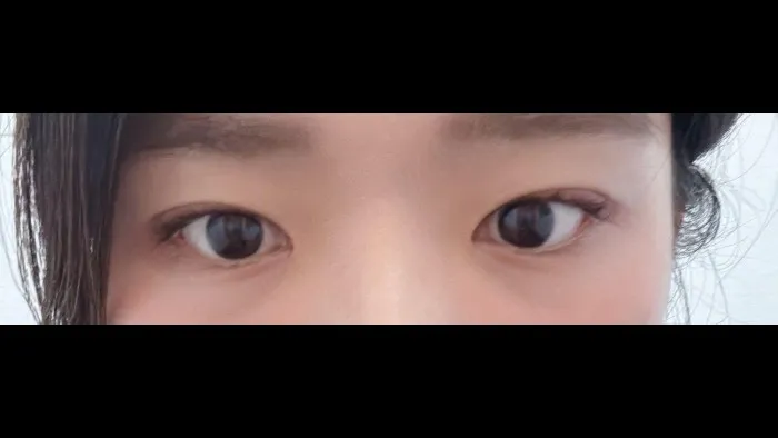 Natural Adhesion Double Eyelid Surgery — RE&RE PLASTIC SURGERY 5