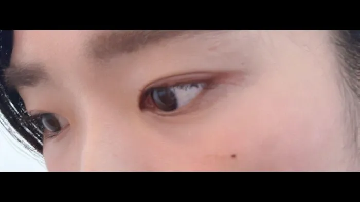 Natural Adhesion Double Eyelid Surgery — RE&RE PLASTIC SURGERY 6