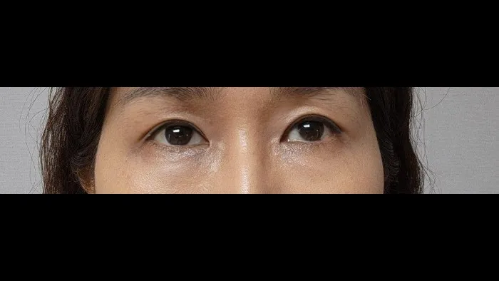 Sub-brow Lift — RE&RE PLASTIC SURGERY 2