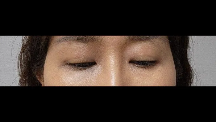 Sub-brow Lift — RE&RE PLASTIC SURGERY 3