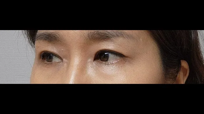 Sub-brow Lift — RE&RE PLASTIC SURGERY 4