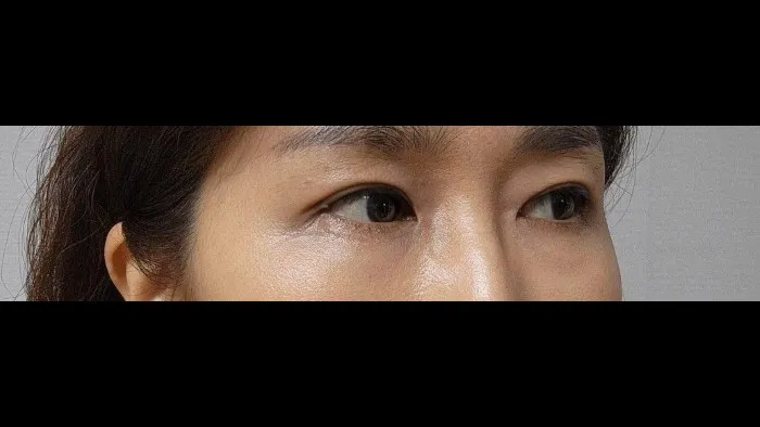 Sub-brow Lift — RE&RE PLASTIC SURGERY 5