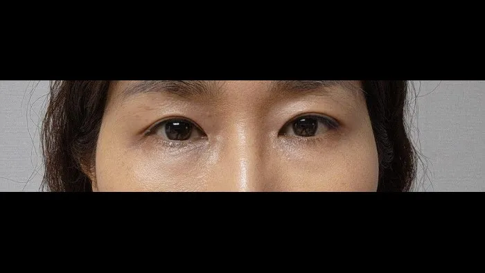 Sub-brow Lift — RE&RE PLASTIC SURGERY 6