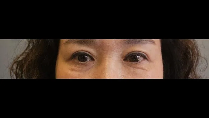 Crease lowering, Lower Blepharoplasty (Aging Eye Rejuvenation), Midface Lift, Full-Face Thread lift, Lower Eyelid Fat Repositioning 1