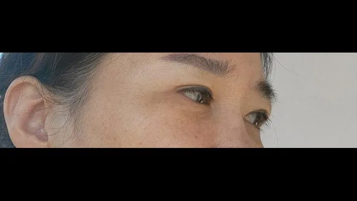 Crease lowering, Lower Blepharoplasty (Aging Eye Rejuvenation), Midface Lift, Full-Face Thread lift, Lower Eyelid Fat Repositioning 2