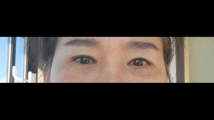 Crease lowering, Lower Blepharoplasty (Aging Eye Rejuvenation), Midface Lift, Full-Face Thread lift, Lower Eyelid Fat Repositioning — RE&RE PLASTIC SURGERY 3