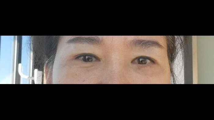Crease lowering, Lower Blepharoplasty (Aging Eye Rejuvenation), Midface Lift, Full-Face Thread lift, Lower Eyelid Fat Repositioning — RE&RE PLASTIC SURGERY 4