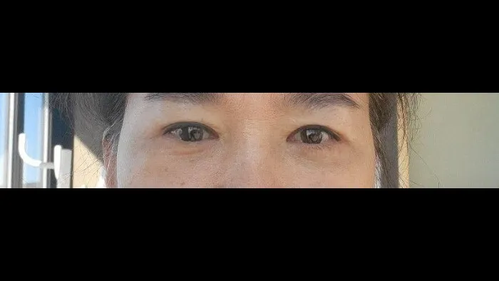 Crease lowering, Lower Blepharoplasty (Aging Eye Rejuvenation), Midface Lift, Full-Face Thread lift, Lower Eyelid Fat Repositioning — RE&RE PLASTIC SURGERY 5