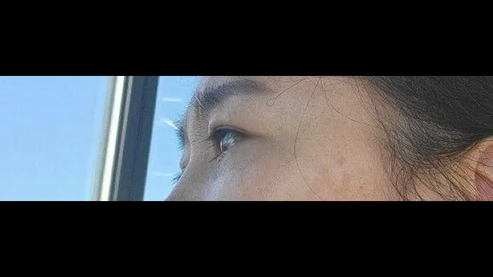Crease lowering, Lower Blepharoplasty (Aging Eye Rejuvenation), Midface Lift, Full-Face Thread lift, Lower Eyelid Fat Repositioning — RE&RE PLASTIC SURGERY 6