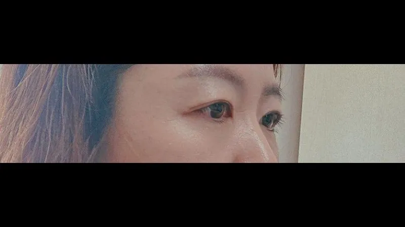 Sub-brow Lift, Lower Eyelid Fat Repositioning — RE&RE PLASTIC SURGERY 2