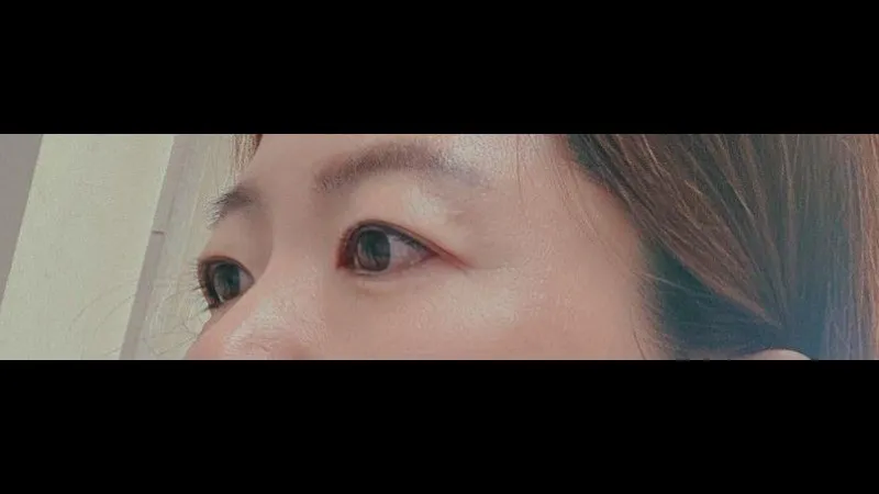 Sub-brow Lift, Lower Eyelid Fat Repositioning — RE&RE PLASTIC SURGERY 3
