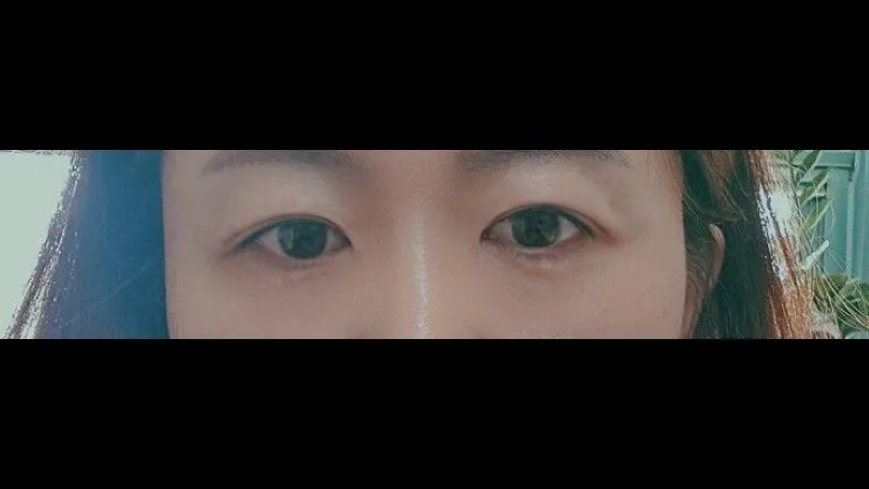 Sub-brow Lift, Lower Eyelid Fat Repositioning — RE&RE PLASTIC SURGERY 4