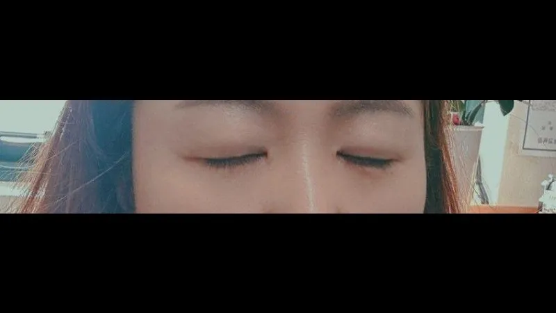 Sub-brow Lift, Lower Eyelid Fat Repositioning — RE&RE PLASTIC SURGERY 5