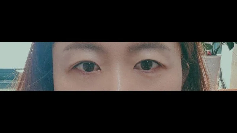 Sub-brow Lift, Lower Eyelid Fat Repositioning — RE&RE PLASTIC SURGERY 6