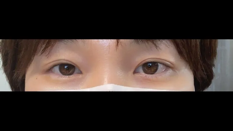 Sub-brow Lift — RE&RE PLASTIC SURGERY 2