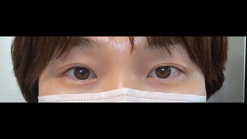 Sub-brow Lift — RE&RE PLASTIC SURGERY 5