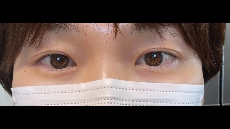 Sub-brow Lift — RE&RE PLASTIC SURGERY 6