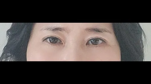 Sub-brow Lift, Lower Eyelid Fat Grafting — RE&RE PLASTIC SURGERY 2