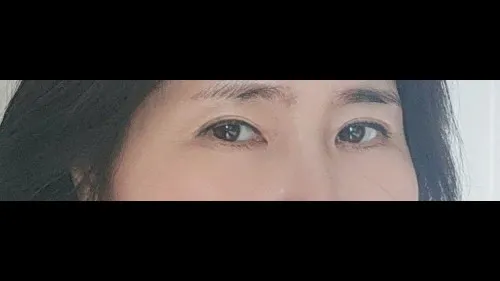 Sub-brow Lift, Lower Eyelid Fat Grafting — RE&RE PLASTIC SURGERY 3