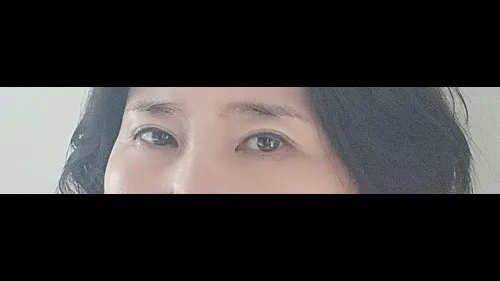 Sub-brow Lift, Lower Eyelid Fat Grafting — RE&RE PLASTIC SURGERY 4