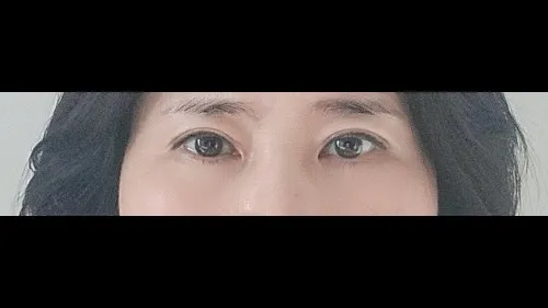 Sub-brow Lift, Lower Eyelid Fat Grafting — RE&RE PLASTIC SURGERY 5