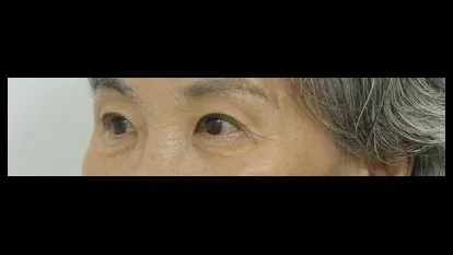 Sub-brow Lift — RE&RE PLASTIC SURGERY 2