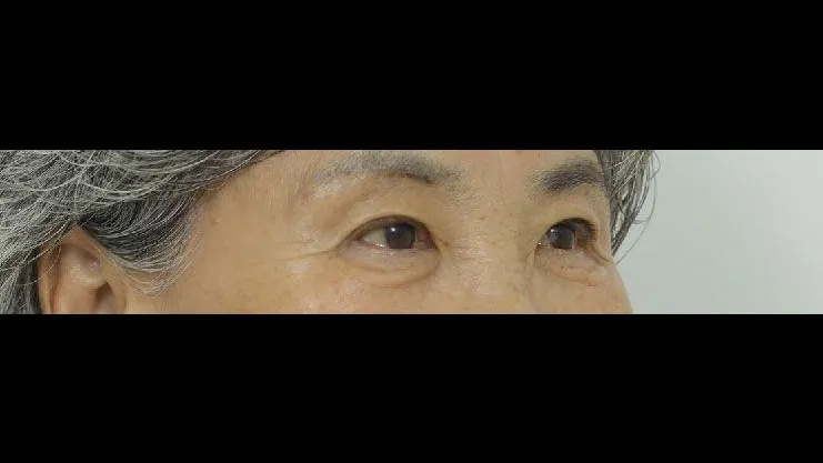 Sub-brow Lift — RE&RE PLASTIC SURGERY 3