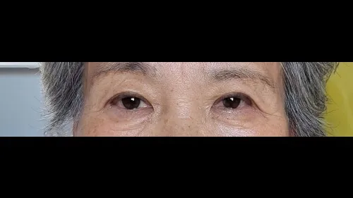 Sub-brow Lift — RE&RE PLASTIC SURGERY 4