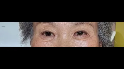 Sub-brow Lift — RE&RE PLASTIC SURGERY 5