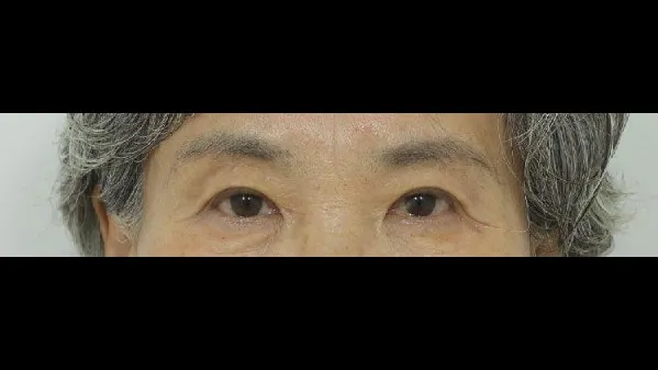 Sub-brow Lift — RE&RE PLASTIC SURGERY 6