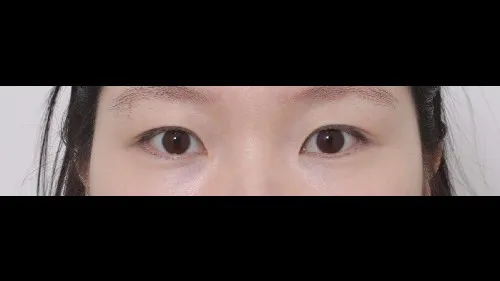 Partial Incision Double Eyelid Surgery 1