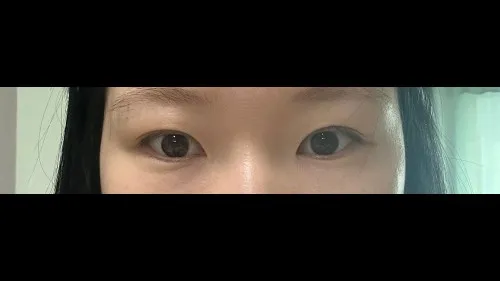 Partial Incision Double Eyelid Surgery 2
