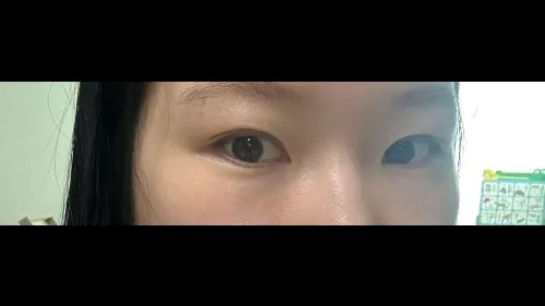 Partial Incision Double Eyelid Surgery — RE&RE PLASTIC SURGERY 3