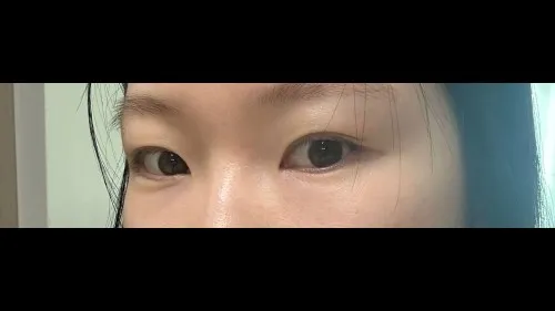 Partial Incision Double Eyelid Surgery — RE&RE PLASTIC SURGERY 4