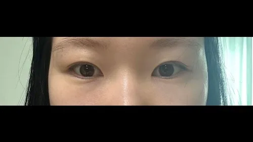 Partial Incision Double Eyelid Surgery — RE&RE PLASTIC SURGERY 5