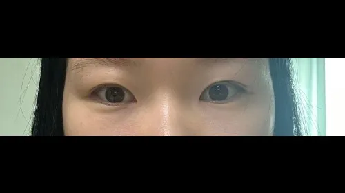 Partial Incision Double Eyelid Surgery — RE&RE PLASTIC SURGERY 6